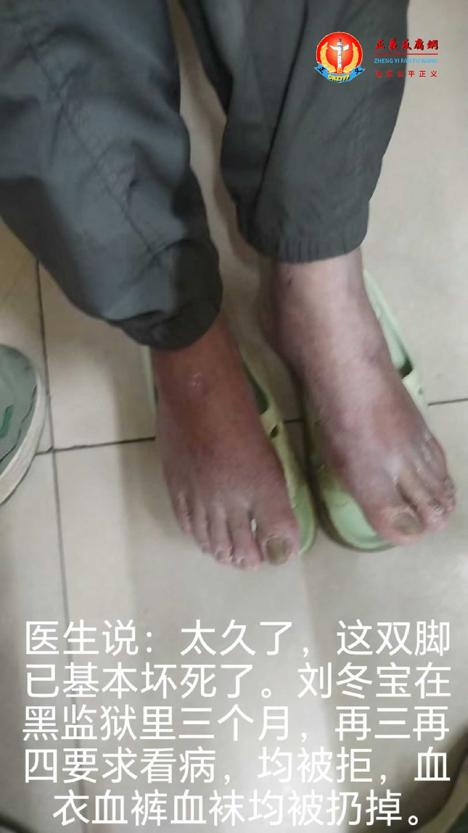访民刘冬宝在黑监狱里三个月，再三再四要求看病，均被拒，血衣血裤血袜均被扔掉。医生说：“太久了，这双脚已基本坏死了。”.jpg