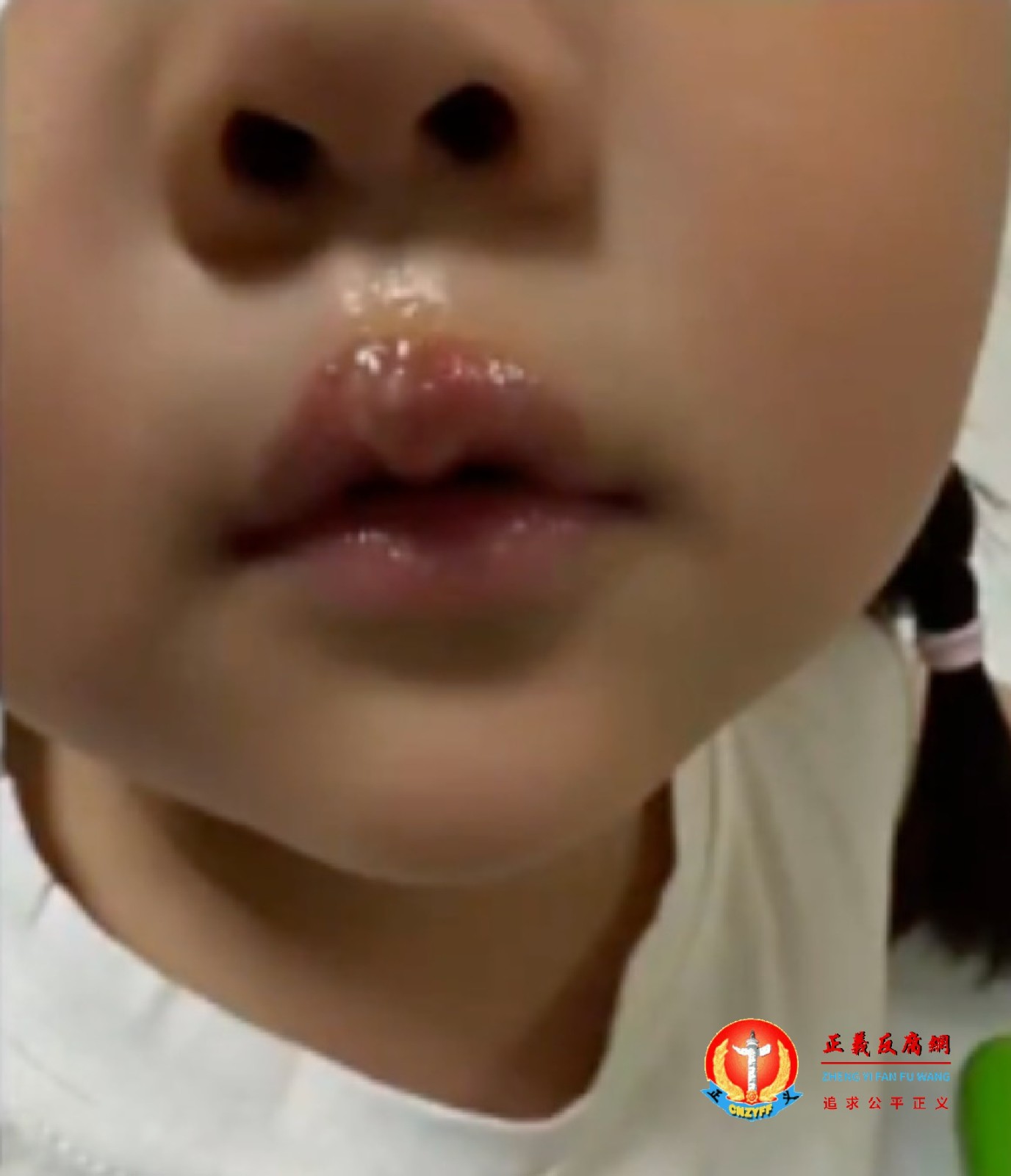 江苏徐州丰县一名幼儿被老师用热熔胶故意烫伤嘴唇,并遭到虐待体罚。.jpg 江苏徐州丰县一名幼儿被老师用热熔胶故意烫伤嘴唇,并遭到虐待体罚。.jpg